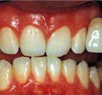 bielenie zub