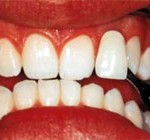 bielenie zub